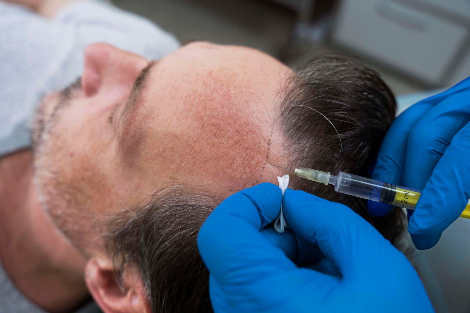 Hair transplant patient consultation